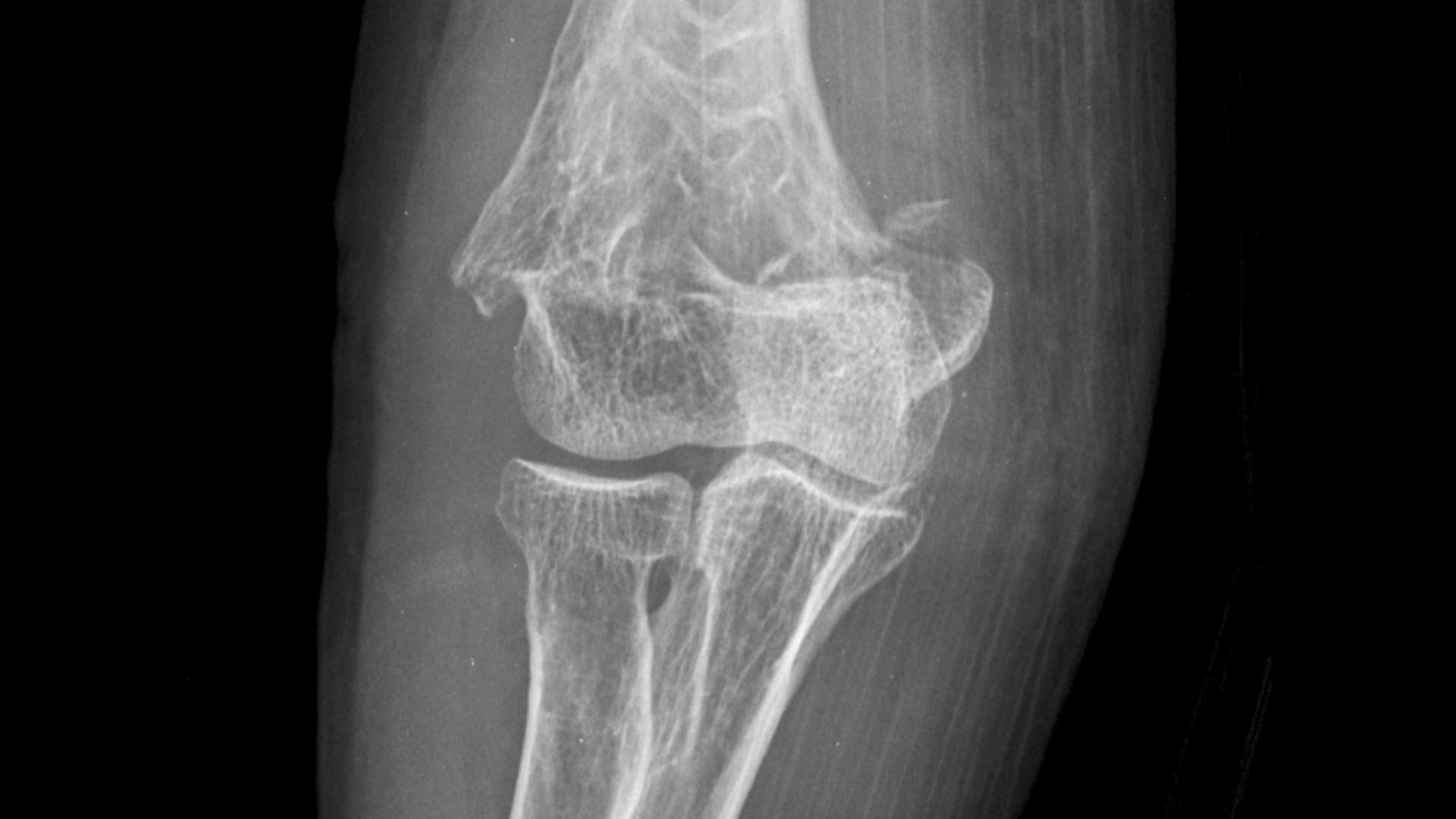 Injuries Commonly Seen in a Buckeye Bicycle Accident